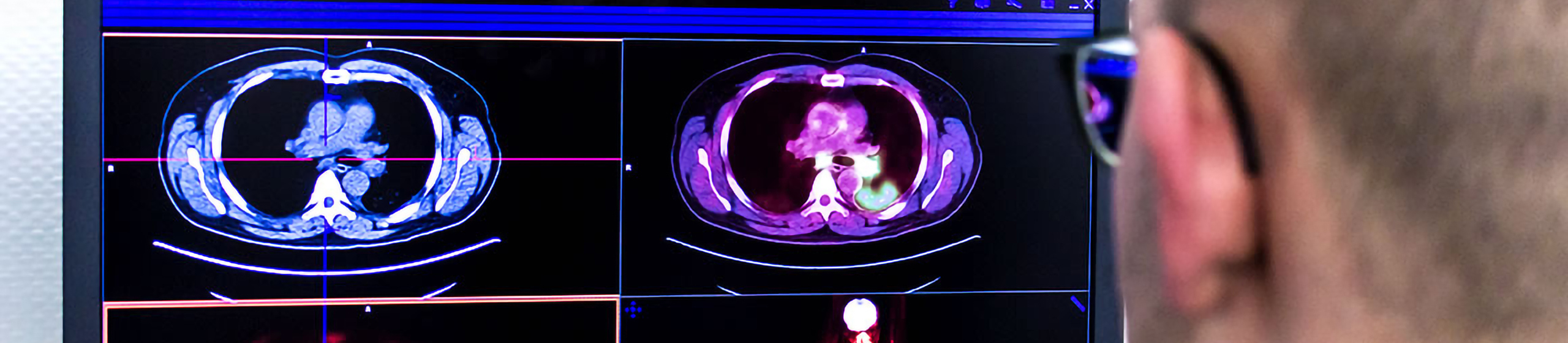 DOTATOC PET-CT - Nuklearmedizin Siegen | Kreuztal